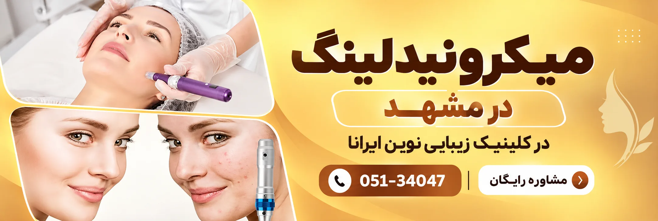 میکرونیدلینگ در کلینیک نوین ایرانا